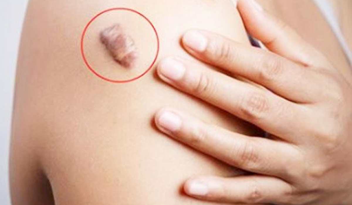 Natural Remedies to Get Rid of Keloids
